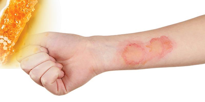 آیا ترکیبات عسل ضد قارچ است و باعث بهبودی این بیماری می شود؟